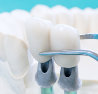 Имплантация при отсутствии зубов