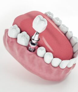 Зубные импланты MegaGen