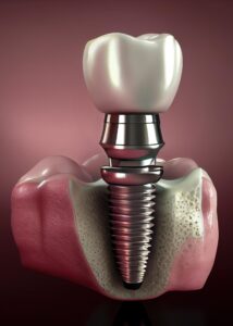 Одномоментная имплантация