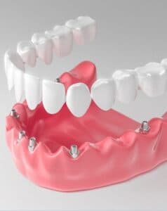 Циркониевые коронки на зуб